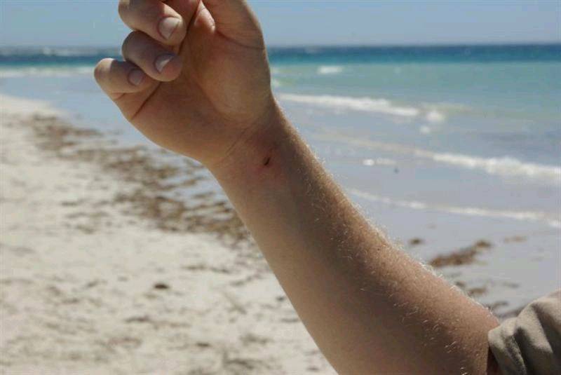 Mega pain after a Stingray barb in the wrist