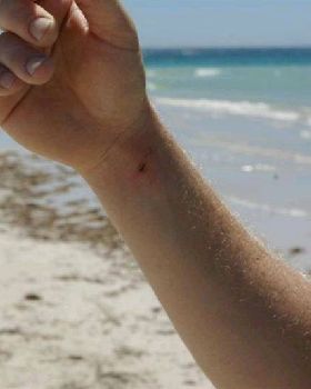 Mega pain after a Stingray barb in the wrist