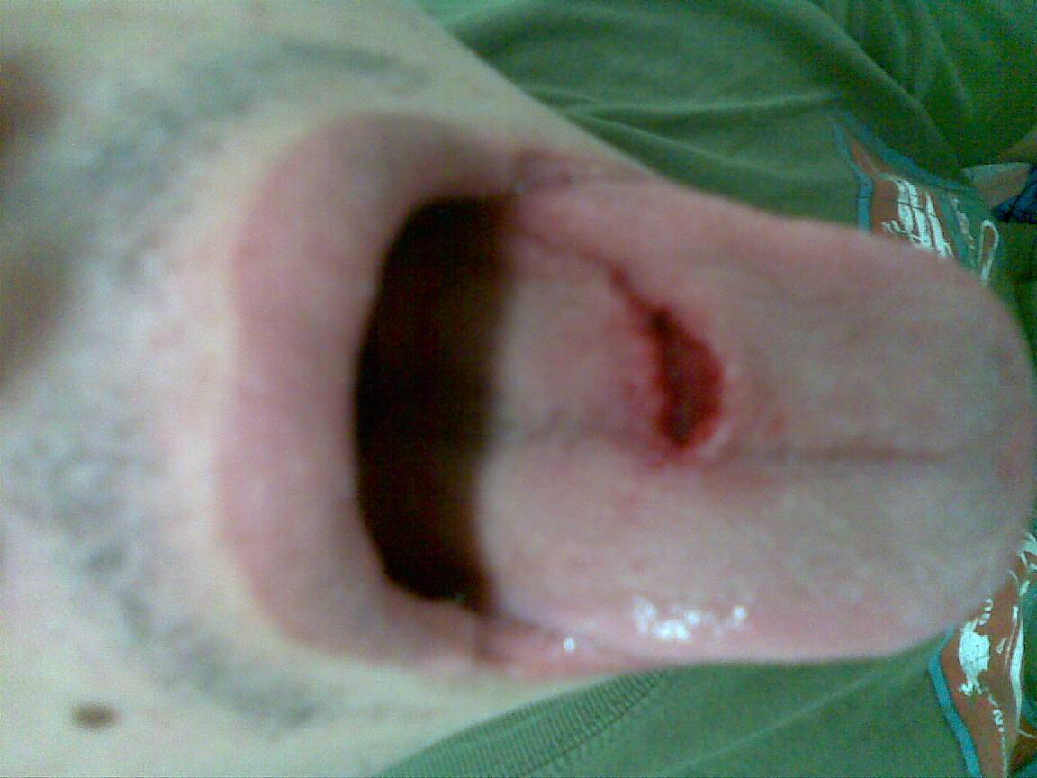 What happens when you stick you tongue out while kiting.1rst Pic when it happend 2nd pic 1week later
