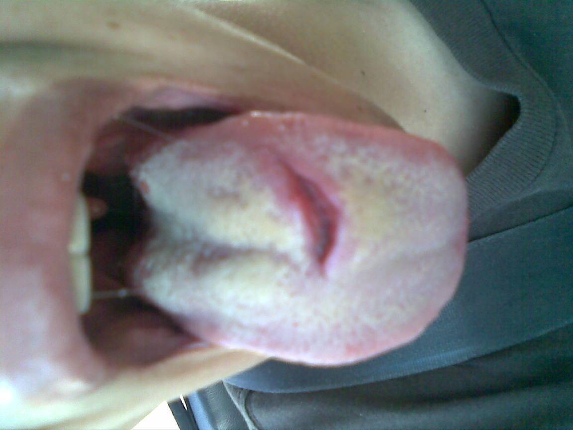 What happens when you stick you tongue out while kiting.1rst Pic when it happend 2nd pic 1week later