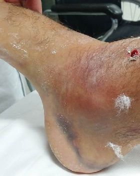 my ankle