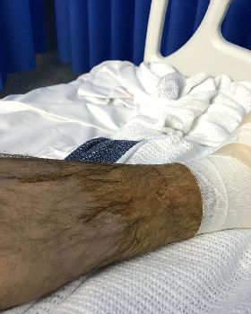 Surgery after breaking my ankle