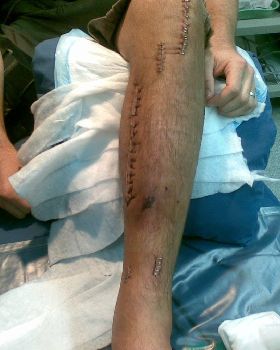 My broken leg after surgery... mmmm im hungry