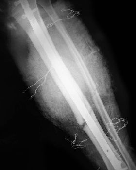 Broken Tibia and Fibula