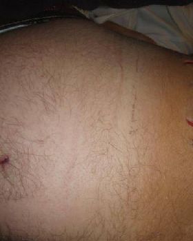 shark bite
