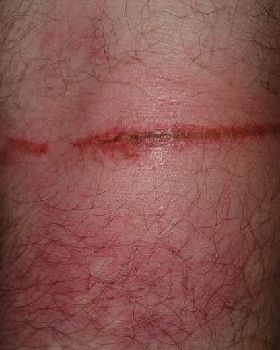 back of knee after getting dragged underwater by kiteline
