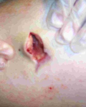 Stingray wound after 5 weeks