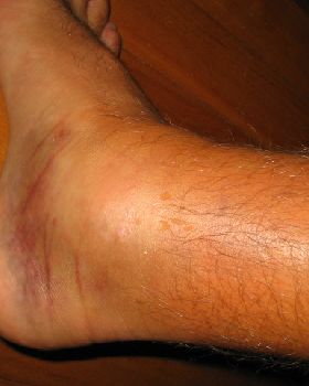 fat ankle..post kiteloop