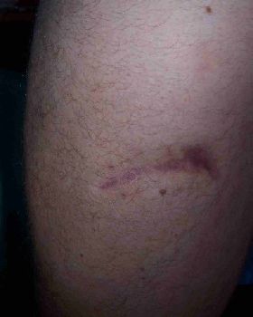 Stingray Scar 11 months later