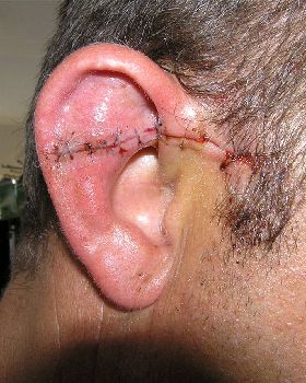 ear slice