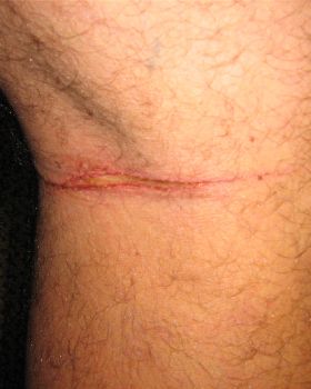 Legs vs lines!!  Not cool!!