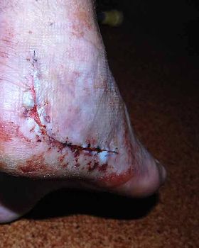 Heel Injury