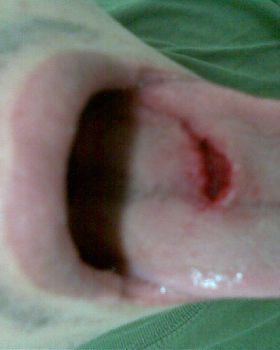 What happens when you stick you tongue out while kiting.1rst Pic when it happend 2nd pic 1week later