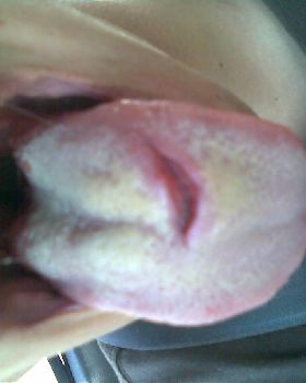 What happens when you stick you tongue out while kiting.1rst Pic when it happend 2nd pic 1week later