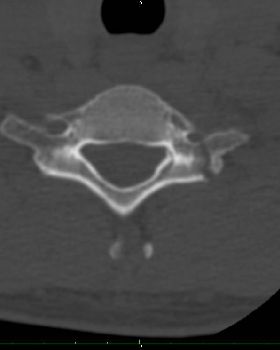 Broken chunk on the right hand side of the image