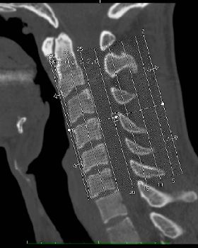 Displaced Spine at the bottom of the lines ( about 2mm)
