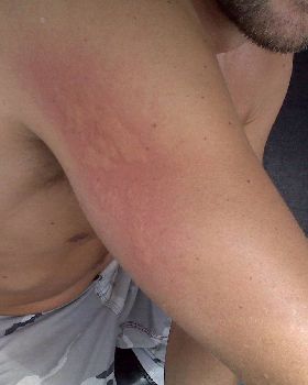 Blue Blubber Jellyfish Sting