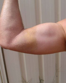 Bruise from wrapped kite lines