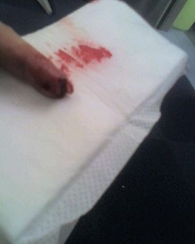 broke my nail kiting