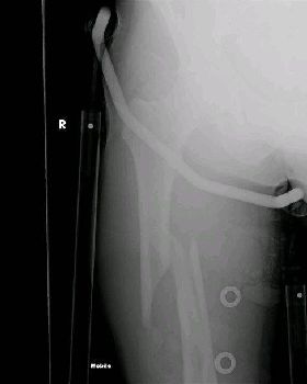 Fractured femure