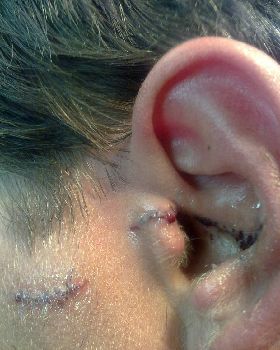 busted ear
