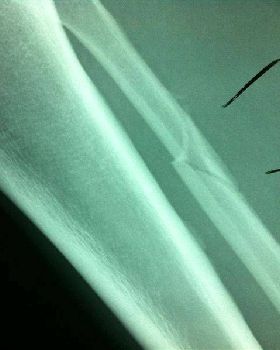 fibula