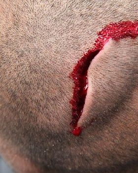Board leash injury