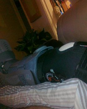 broken leg