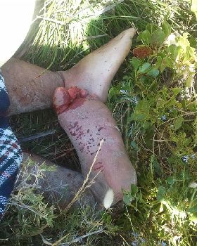 Kite boarding acident