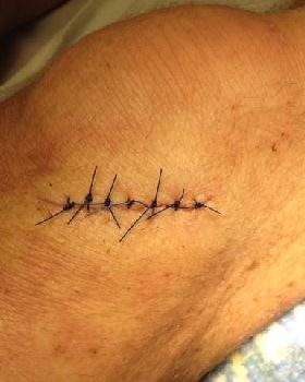 7 stitches
