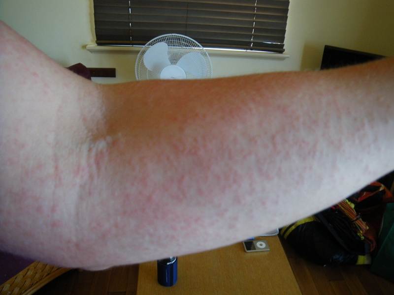 dermatits - sun reaction? itchy as and just about all over my body