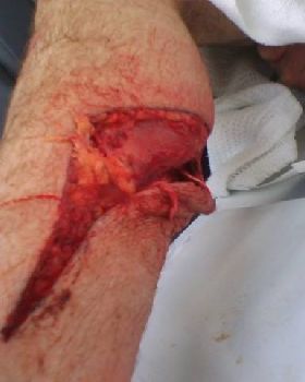 NSW kiter gets injured