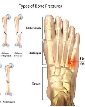 Foot-Fracture-Doctor-NYC