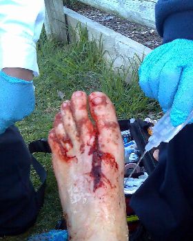 Board Bite