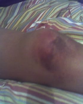 My injured knee