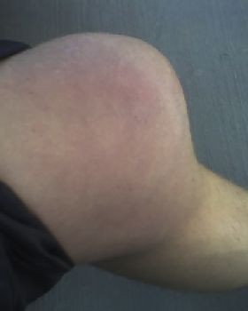 My injured knee