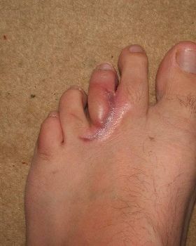 Foot sealant
