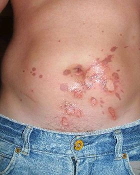 gut burn