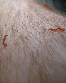 red worms crawling out of my skin