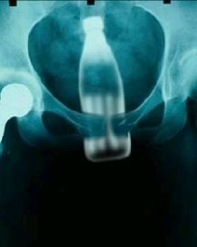 rectal FB