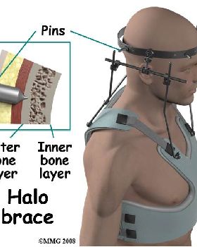 halo