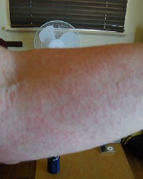 dermatits - sun reaction? itchy as and just about all over my body