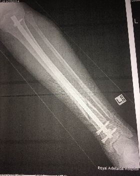 broken tib fib