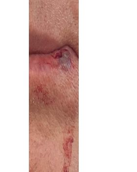 SPlit lip