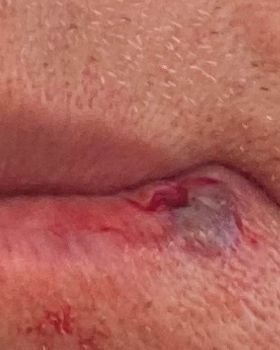 SPlit lip (3)