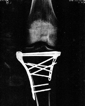 tibial plateau fracture