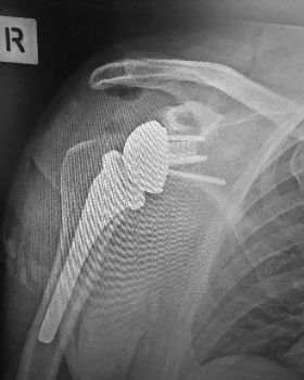Shoulder replacement