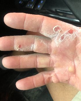 HAND 5