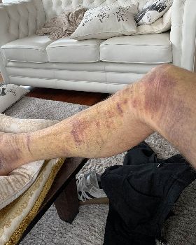 Bruised from jumping off the front