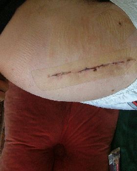 scar